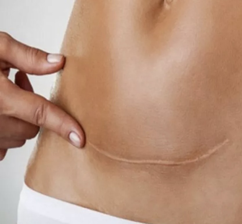 Fisioestetica_Trattamento cocatrici e cheloidi_FORMA Poliambulatorio